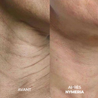 Système de micro-infusion Nymeria™