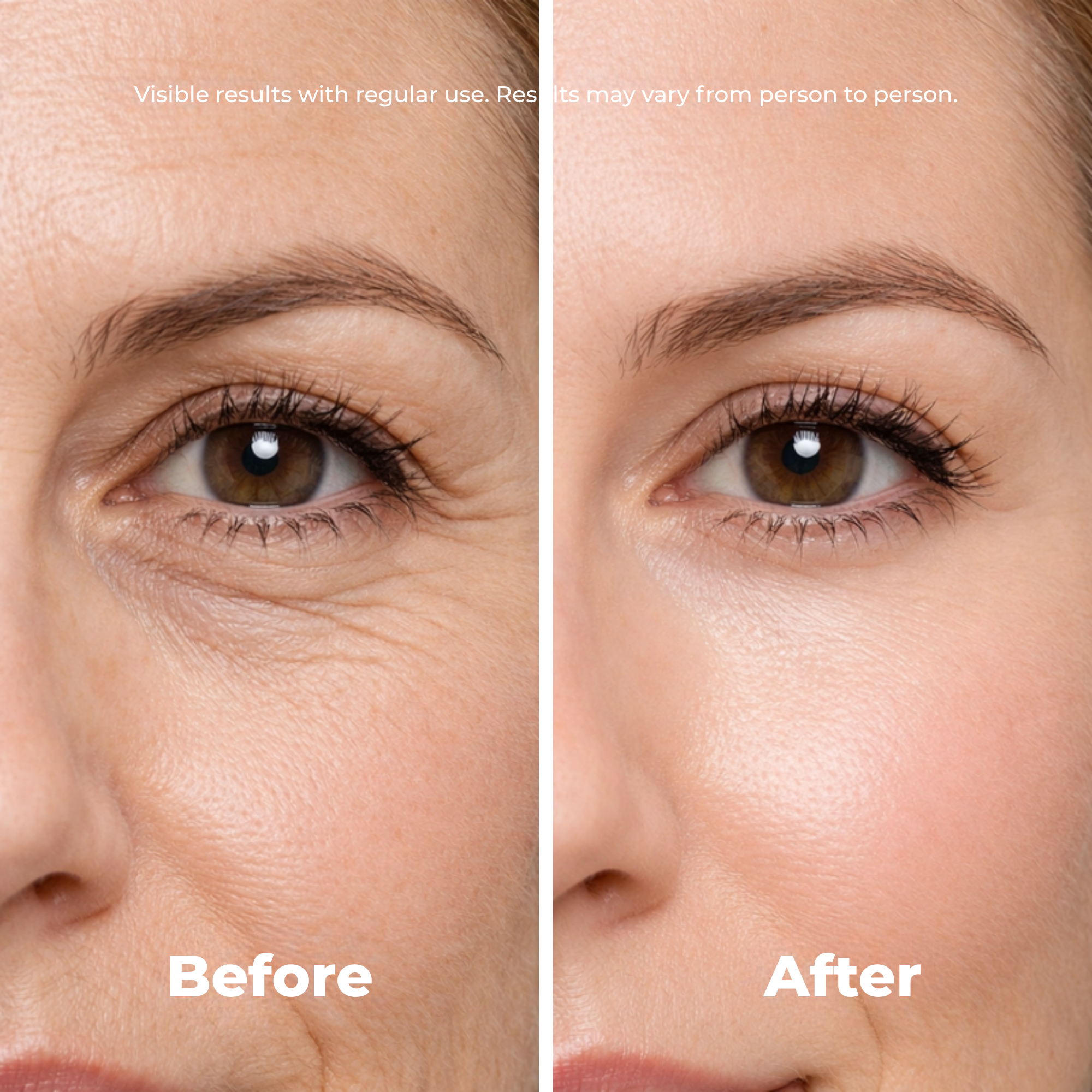 Eye contour lifting patches