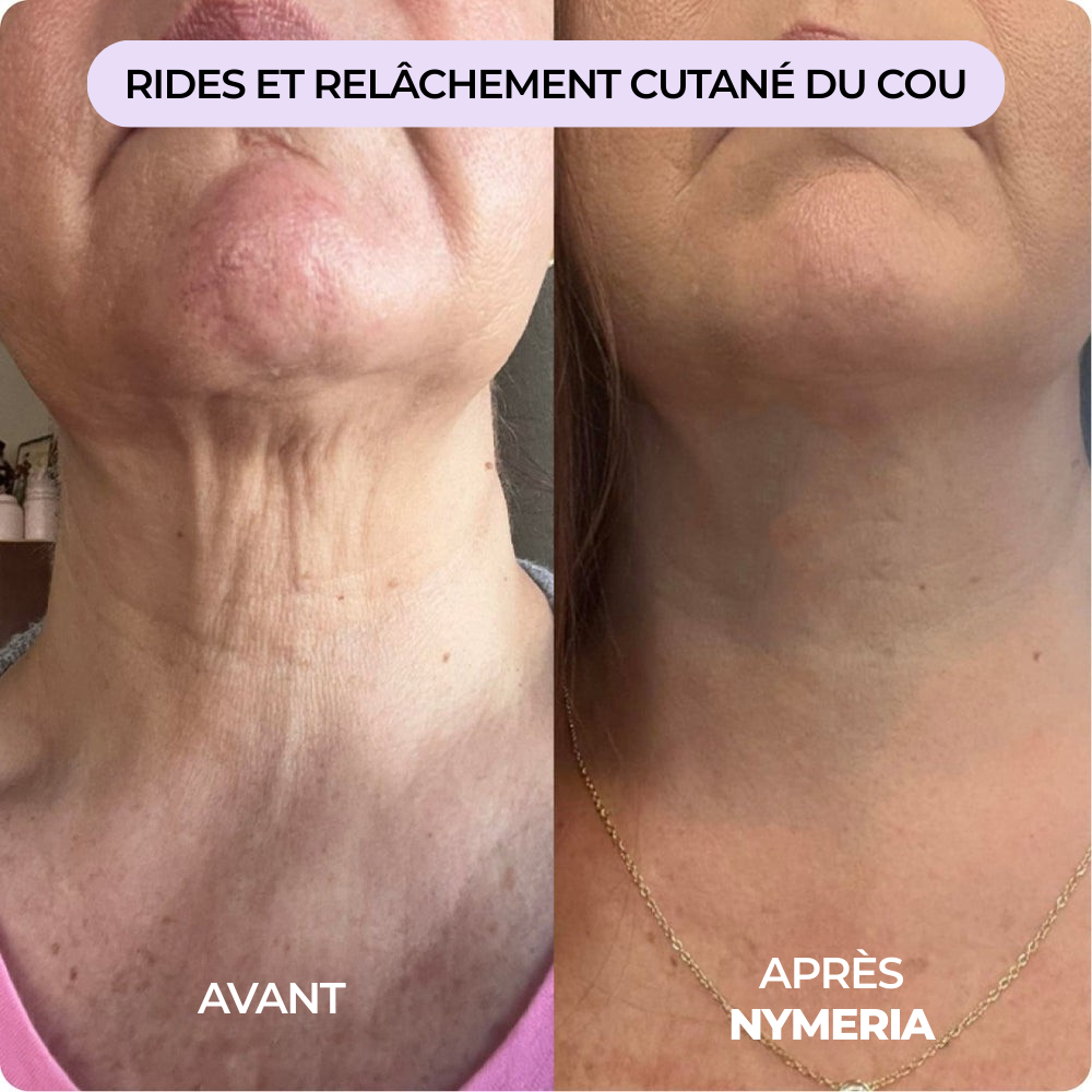 Système de micro-infusion Nymeria™