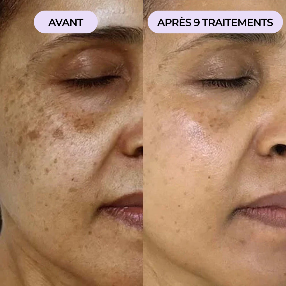 Tâches pigmentaires & tâches de vieillesse