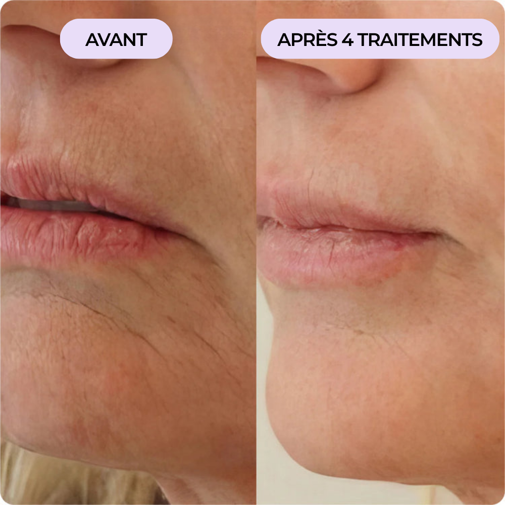 Lèvres fines & ridées