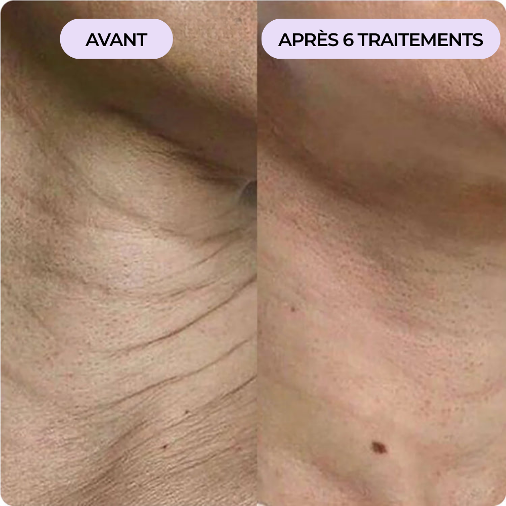 Peau du cou ridée et relâchée