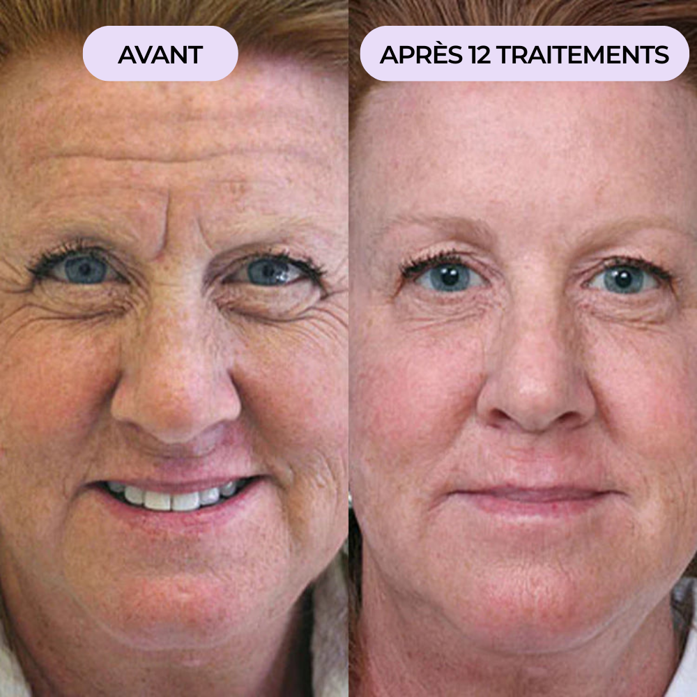 Rides du front & rides d'expression