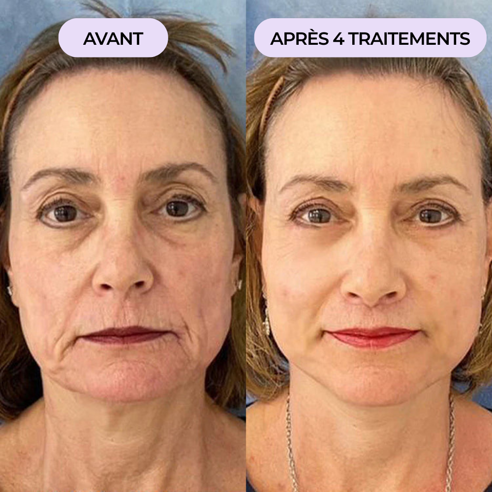 Rides autour de la bouche