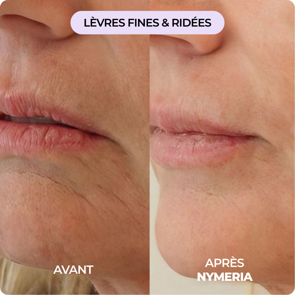 Système de micro-infusion Nymeria™