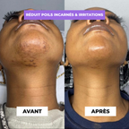 Cyperus Rotondus sérum