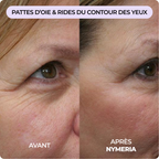 Système de micro-infusion Nymeria™