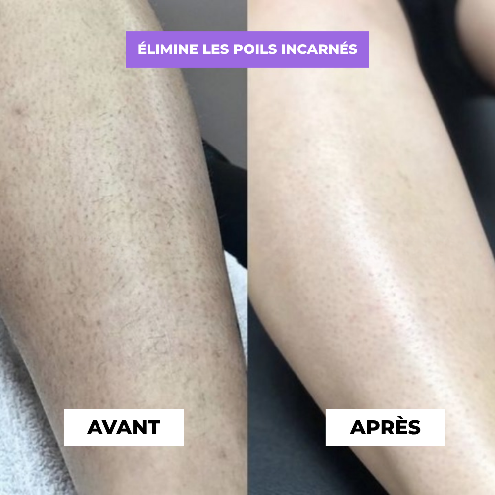 Cyperus Rotondus sérum