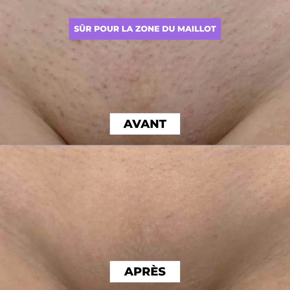 Cyperus Rotondus sérum