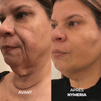 Système de micro-infusion Nymeria™