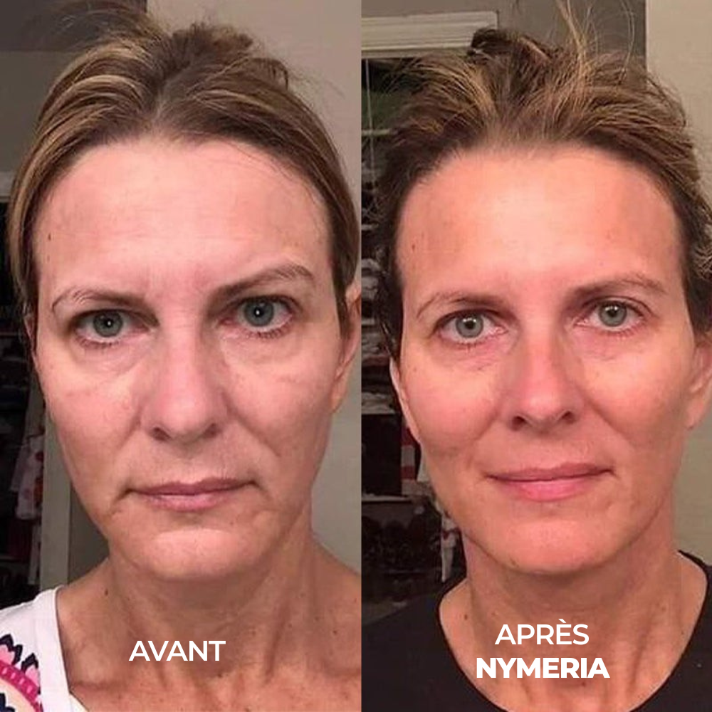 Système de micro-infusion Nymeria™